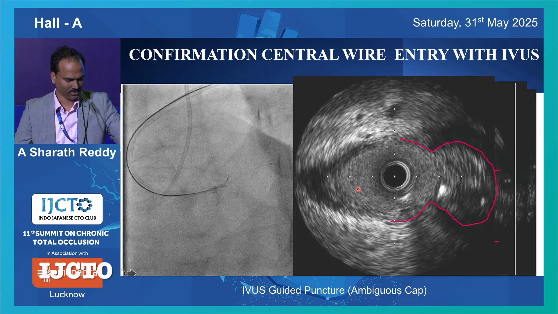 IVUS confirming wire position within media layer