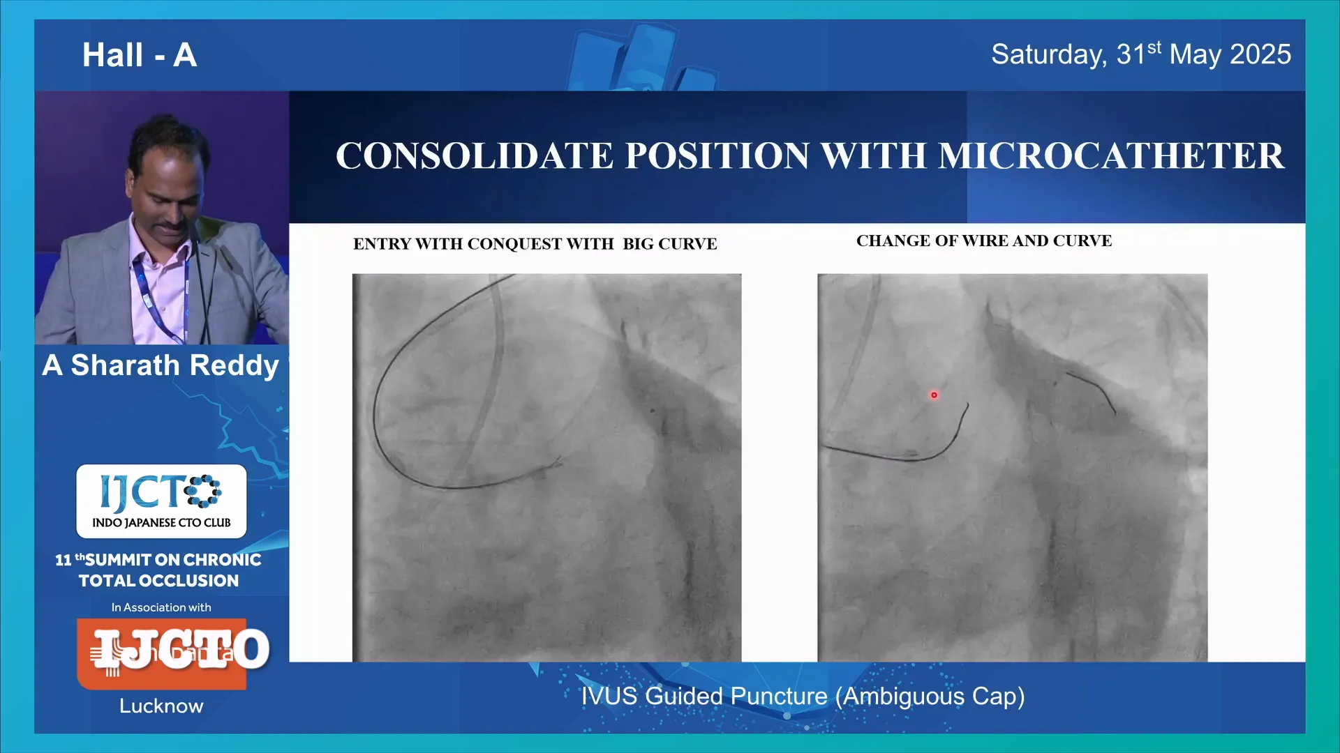 Microcatheter advancement and wire de-escalation