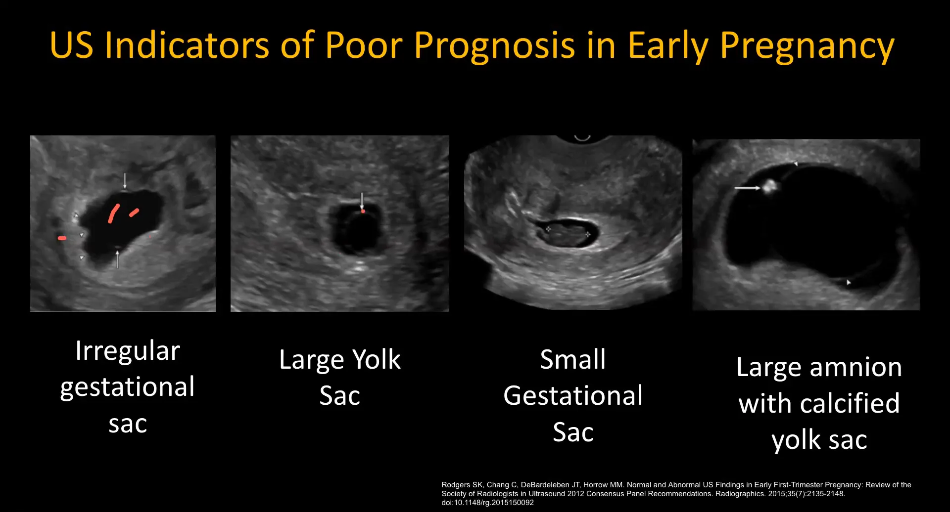 Significant yolk sac size indicating poor prognosis