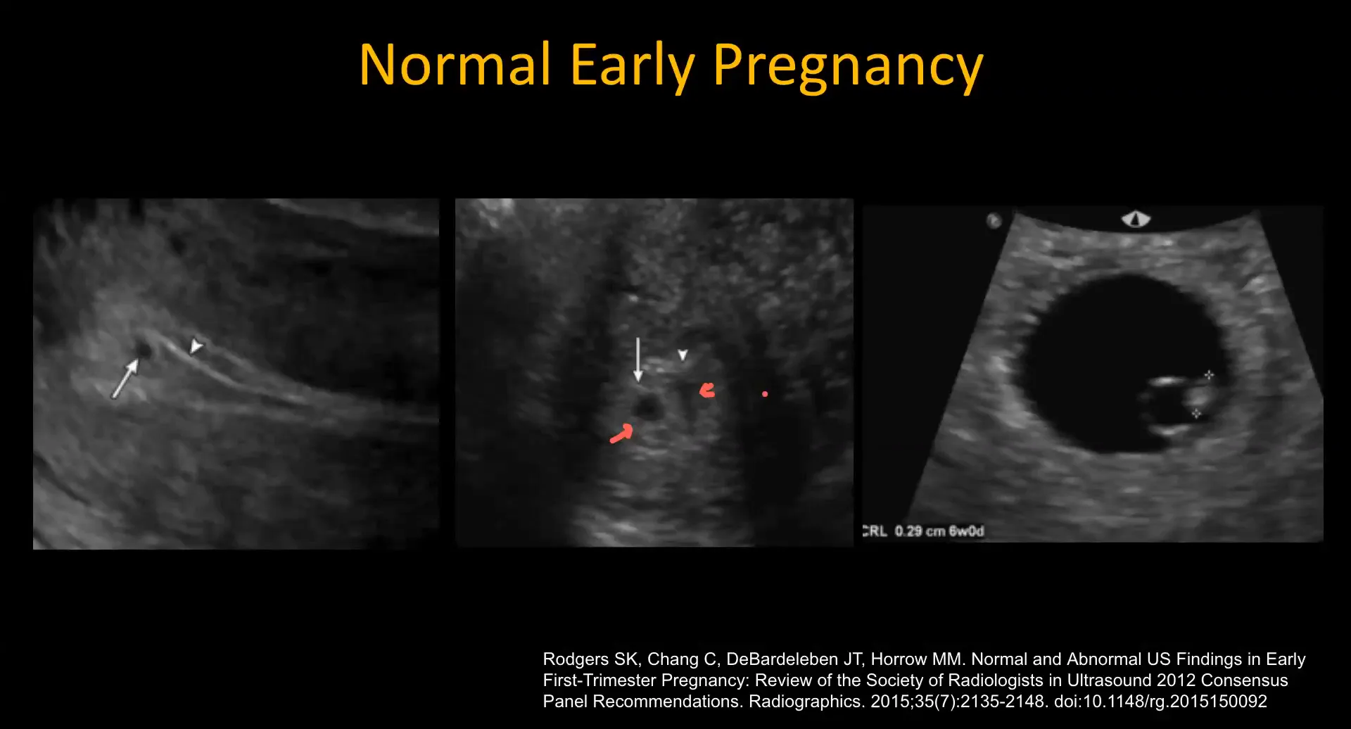 Normal early pregnancy ultrasound showing fetal pole and yolk sac