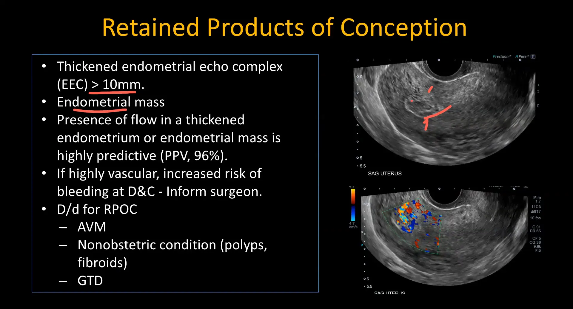 Ultrasound findings of RPOC