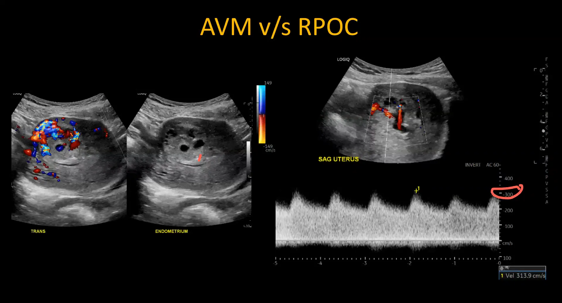 Doppler findings differentiating RPOC from AVM