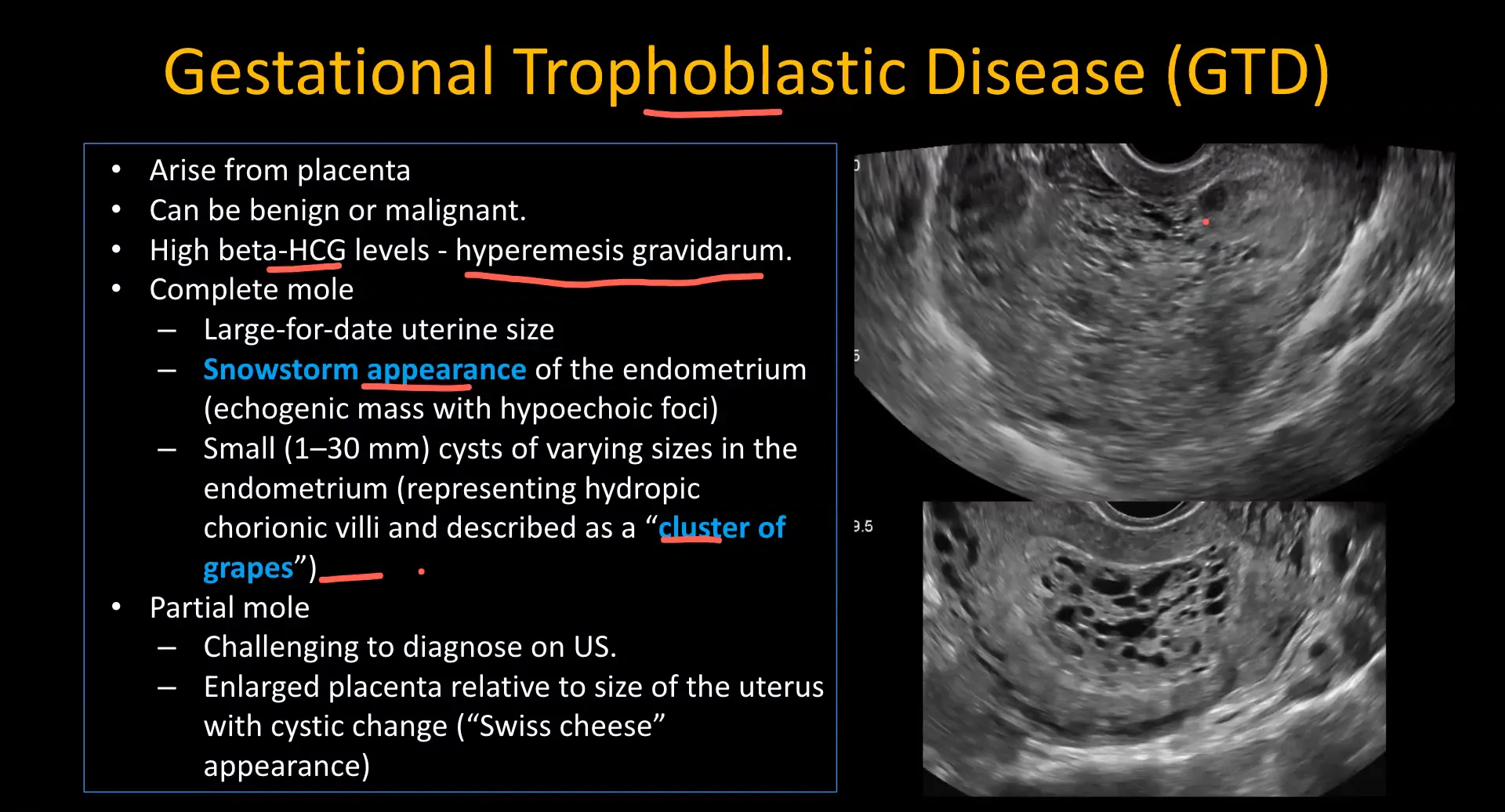 Ultrasound findings of gestational trophoblastic disease