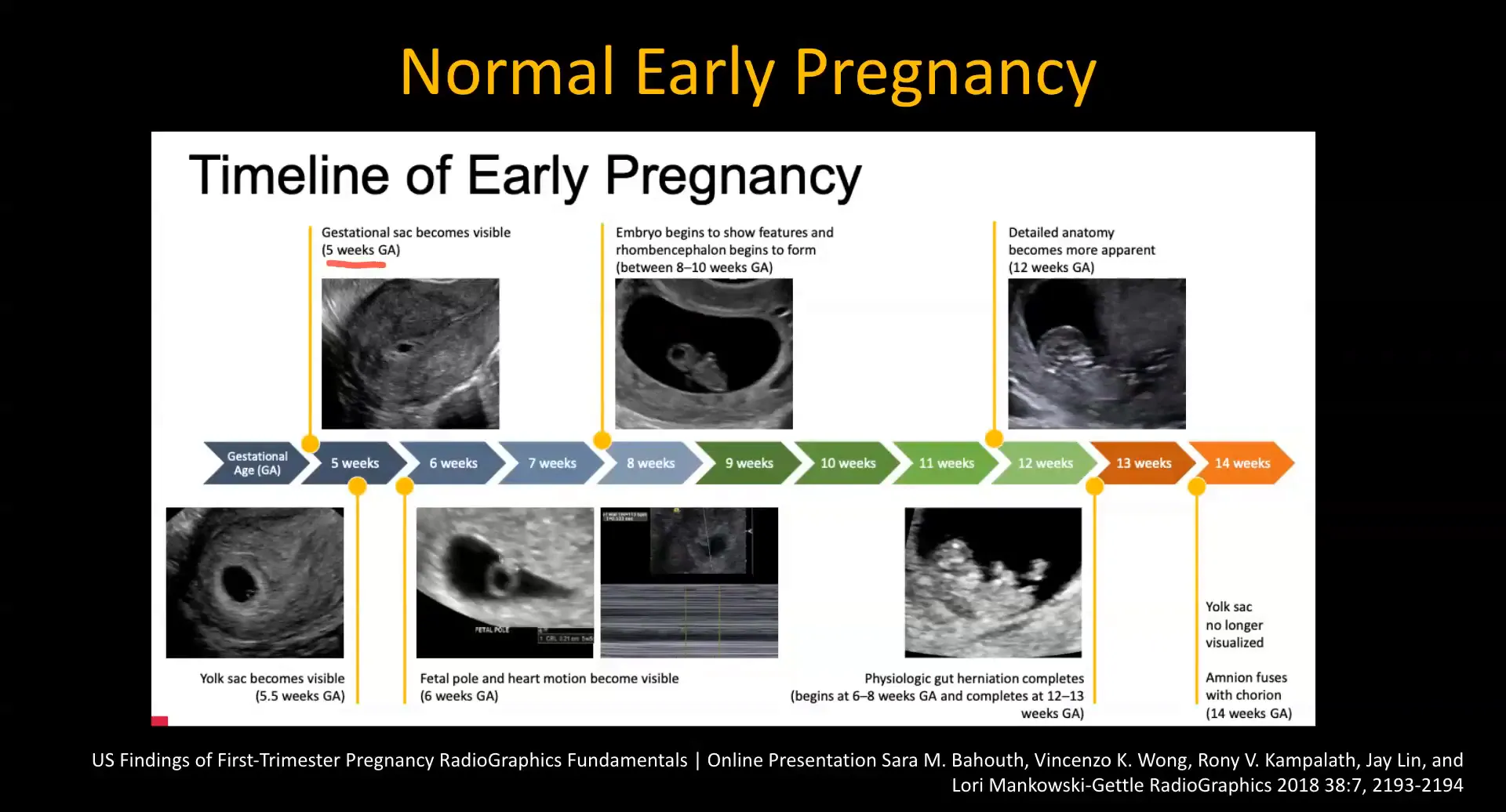 Gestational sac visible at 5 weeks