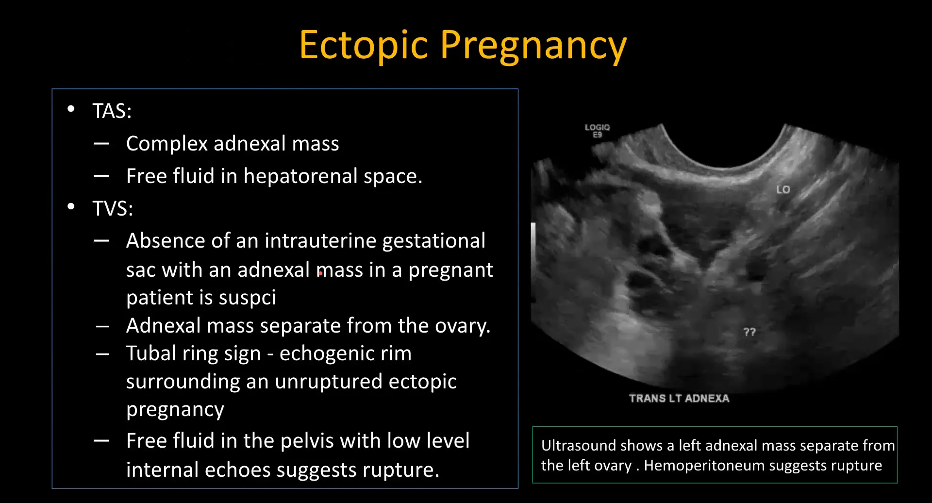 Ultrasound showing adnexal mass indicative of ectopic pregnancy