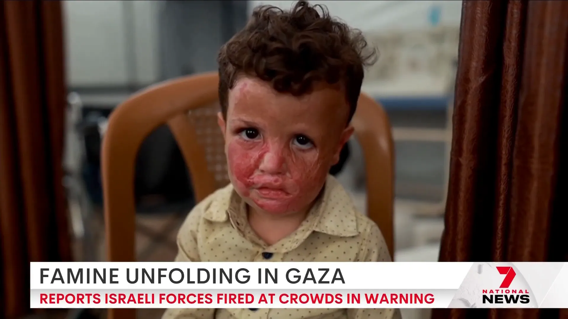 Palestinian children injured in conflict