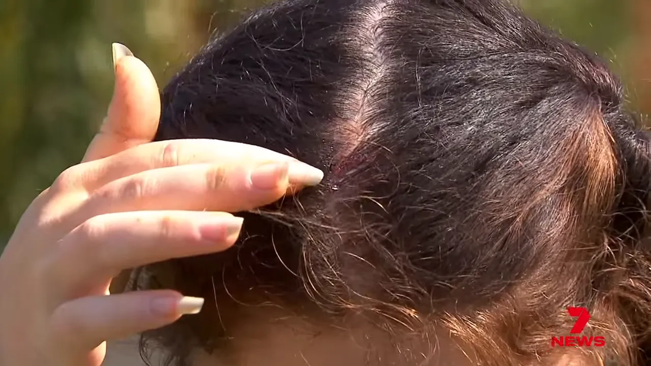 Close-up recreation of a large hailstone described as slicing a boy's face