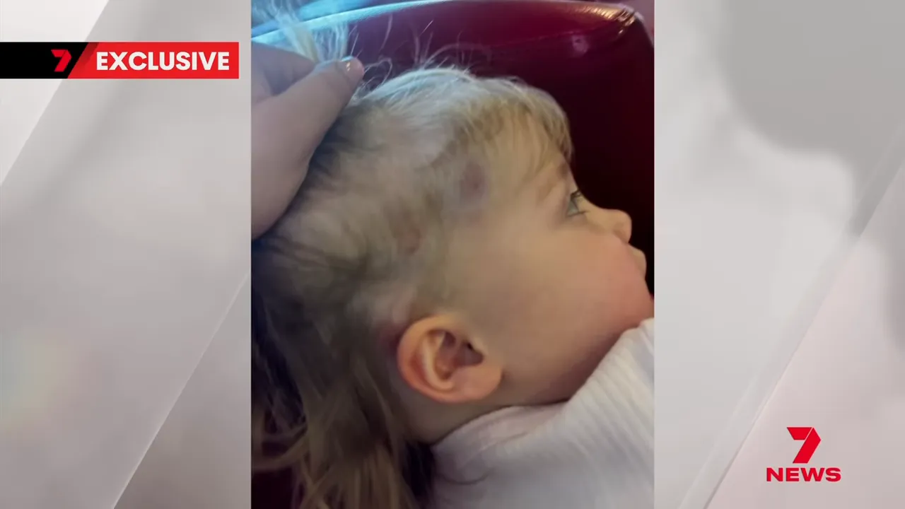 Side of young child's head showing bruises and marks after suspected strike