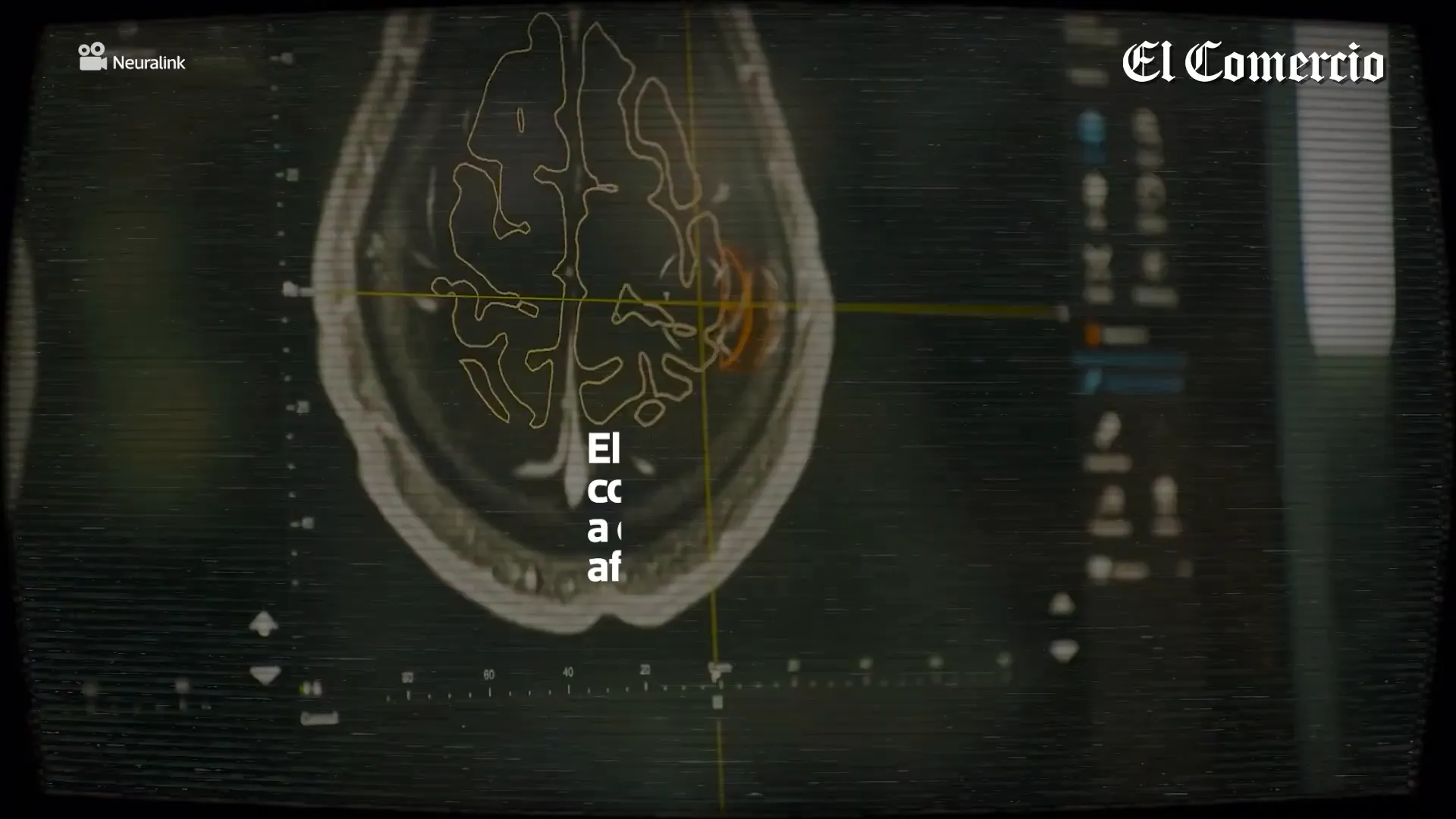 Implantes cerebrales de Neuralink