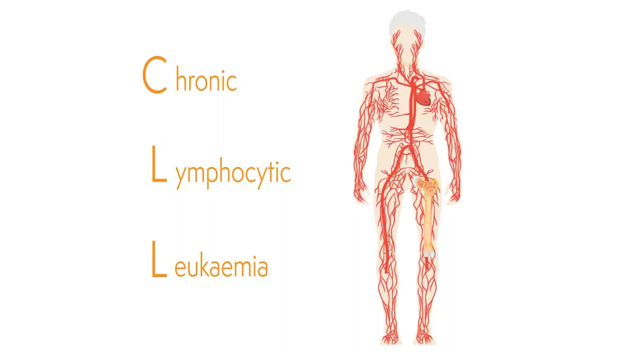 diagram of human body with red blood vessels and highlighted bone marrow alongside 'Chronic Lymphocytic Leukaemia' text