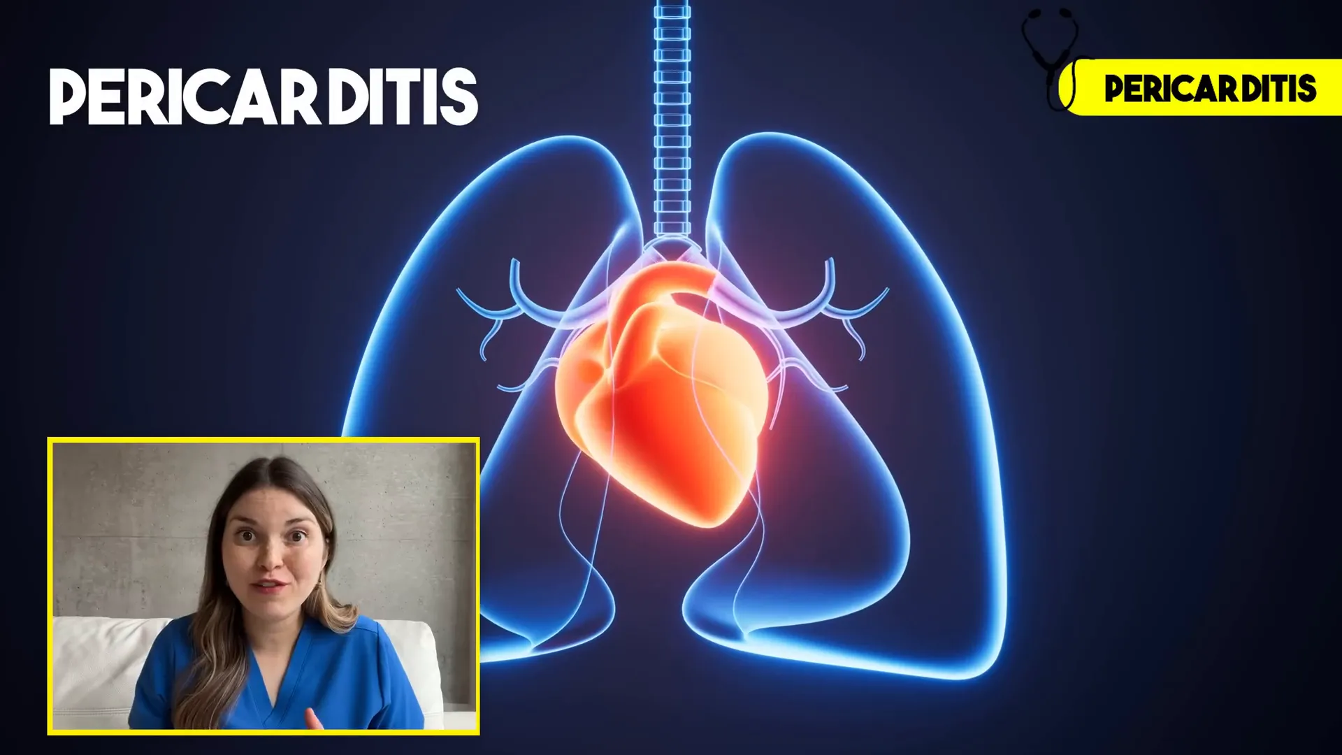 Diagram of pericarditis inflammation around the heart
