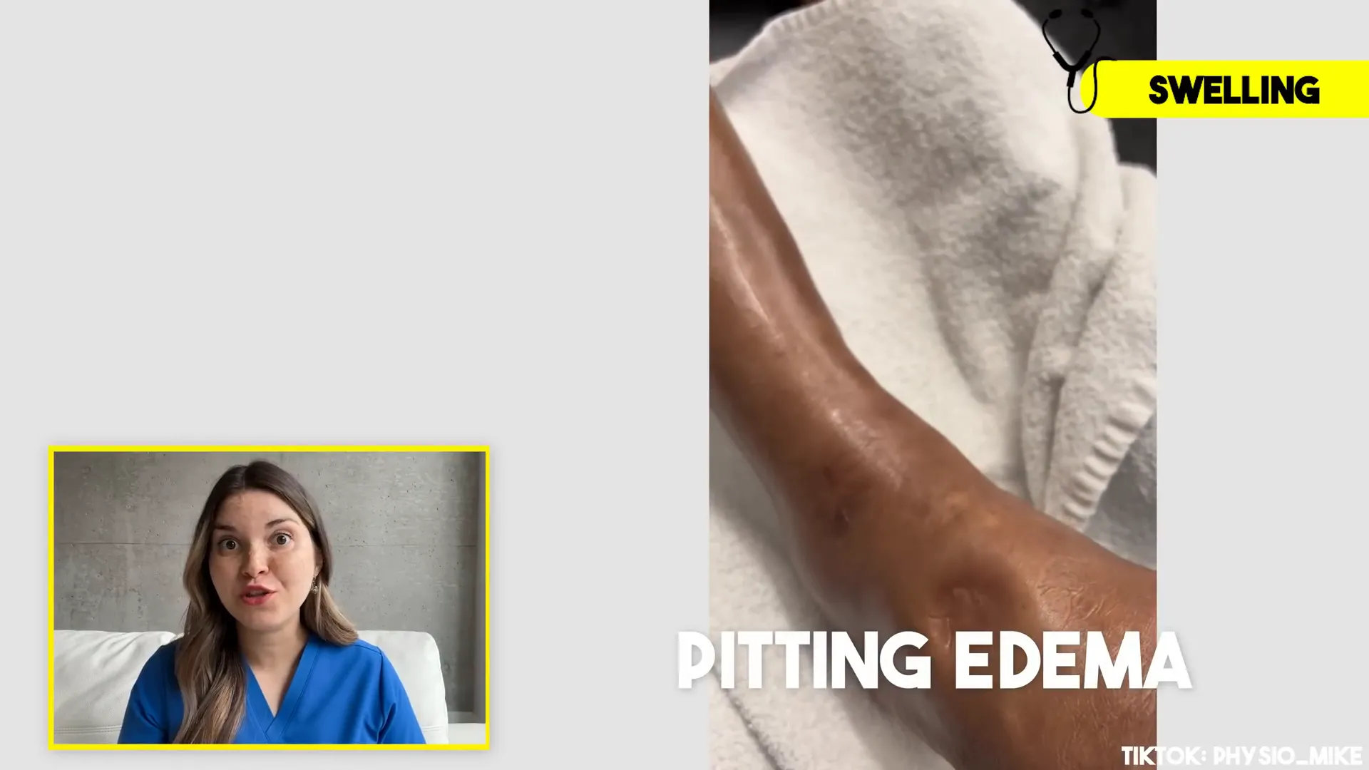 Demonstration of pitting edema test on leg