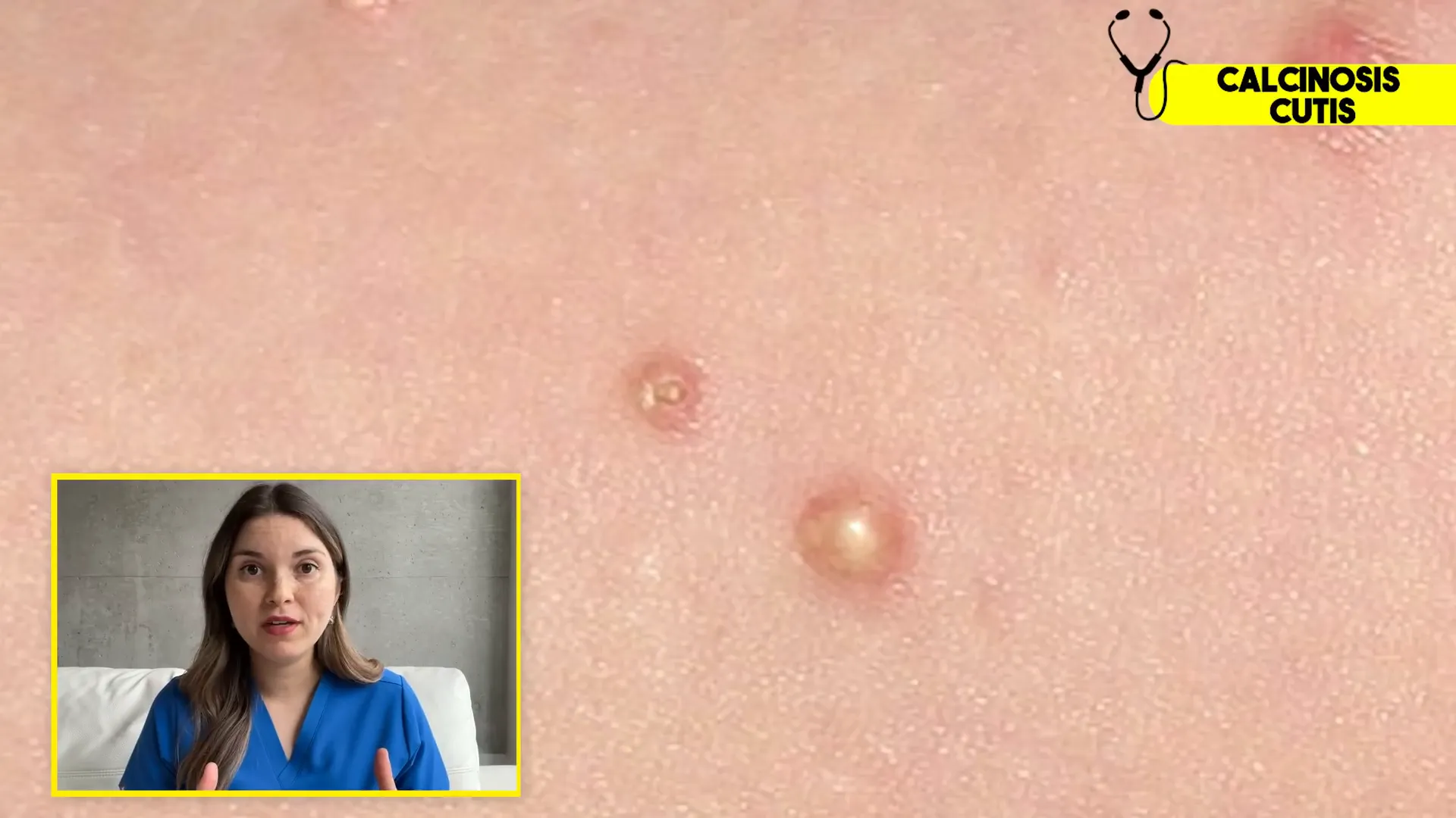 Skin bumps caused by calcinosis cutis