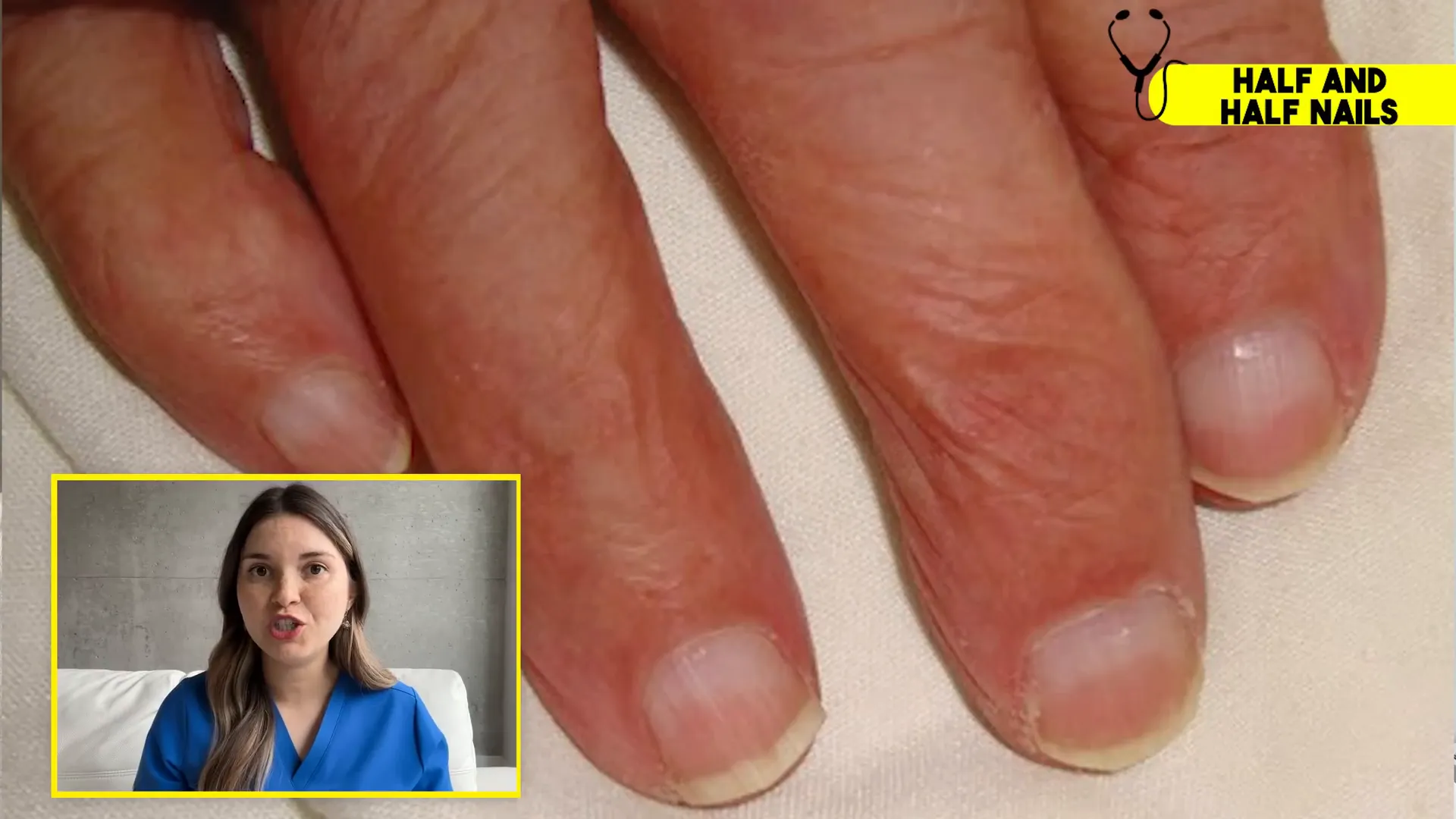 Comparison of normal nails versus half and half nails in kidney disease