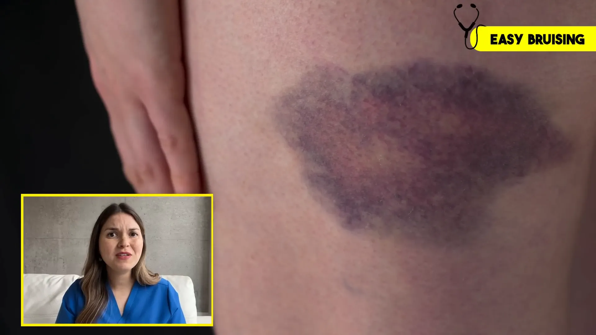 Bruising on skin due to platelet dysfunction