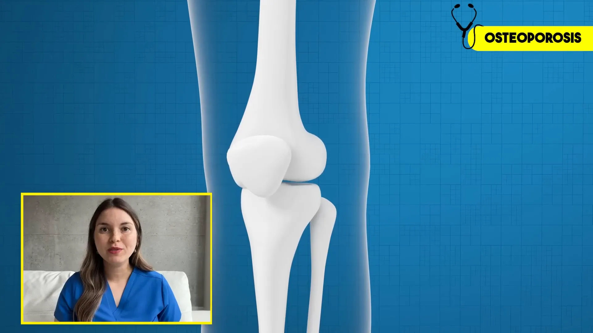 X-ray of osteoporotic bones