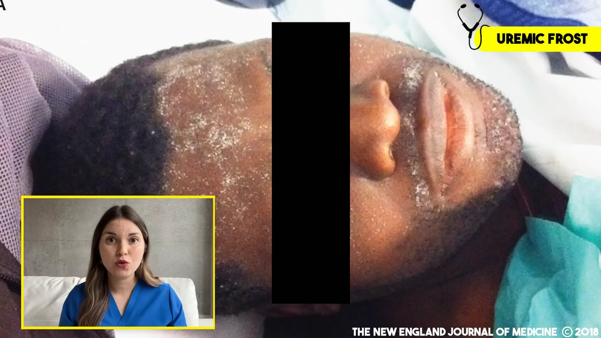 Patient with uremic frost on skin