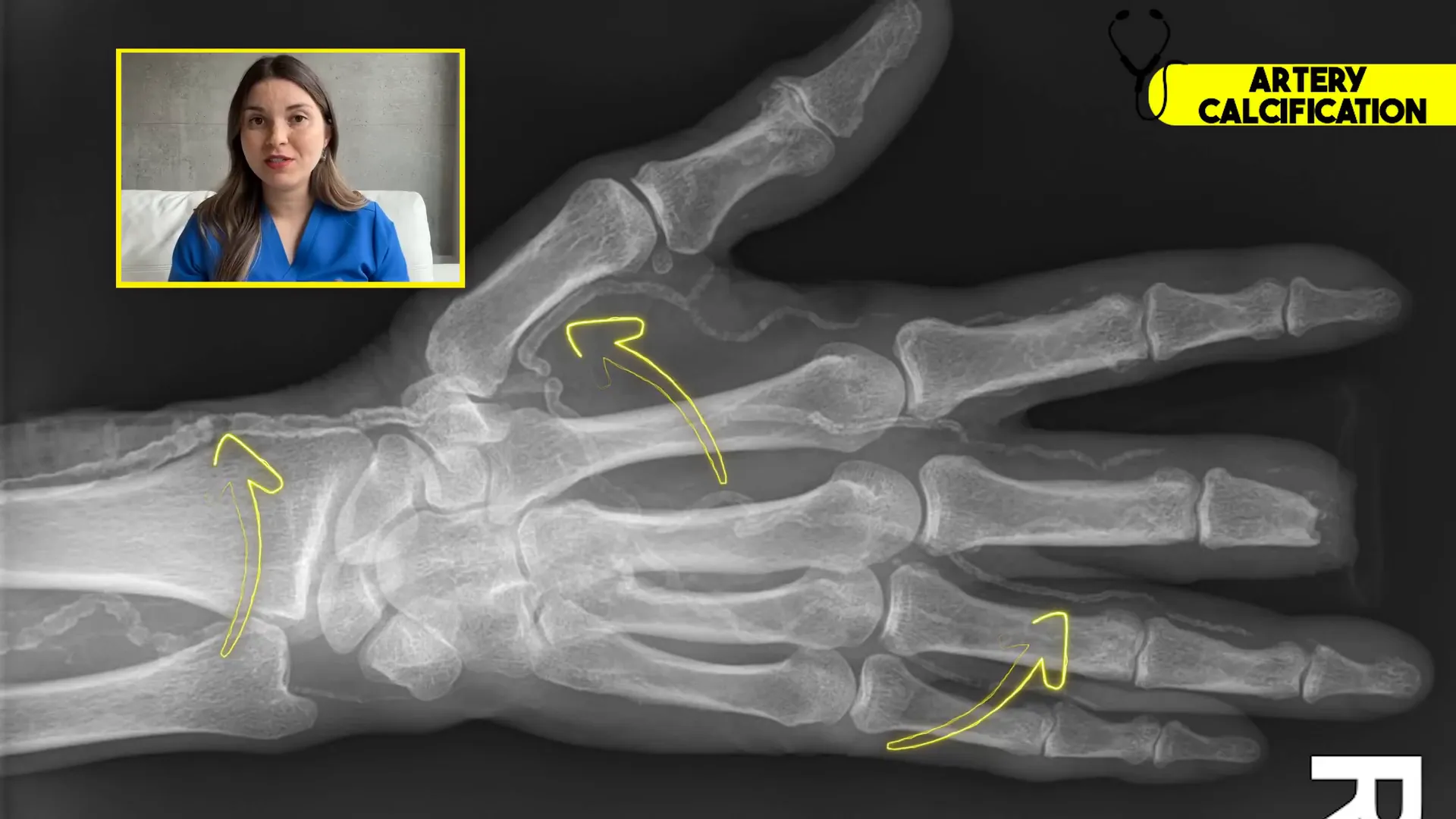 X-ray showing calcified arteries