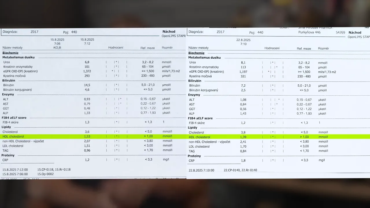 Close-up of lab blood test printout showing liver enzyme values, HDL and total cholesterol, CRP and other markers
