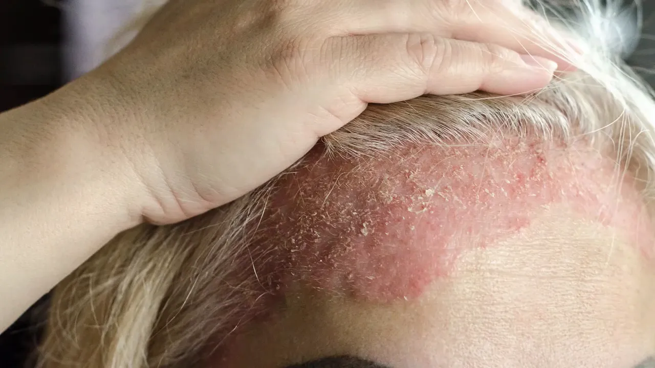 Placa roja y descamativa visible en la línea de implantación del cabello