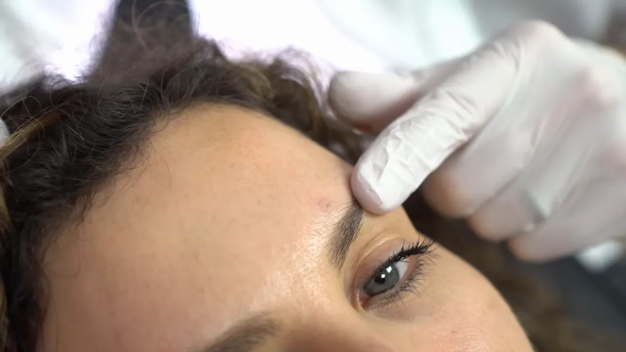 mãos com luvas apontando marca na sobrancelha mostrando ponto de aplicação