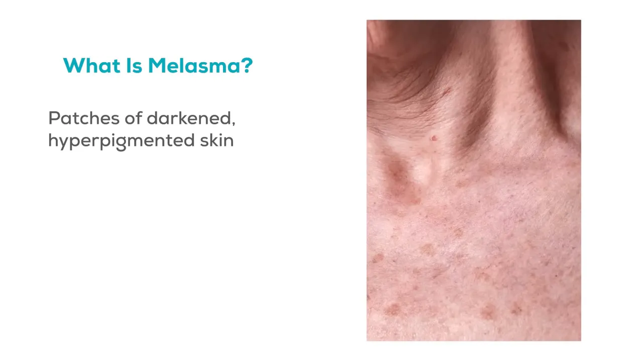 Slide 'What Is Melasma?' com texto 'Patches of darkened, hyperpigmented skin' e foto de pele com manchas