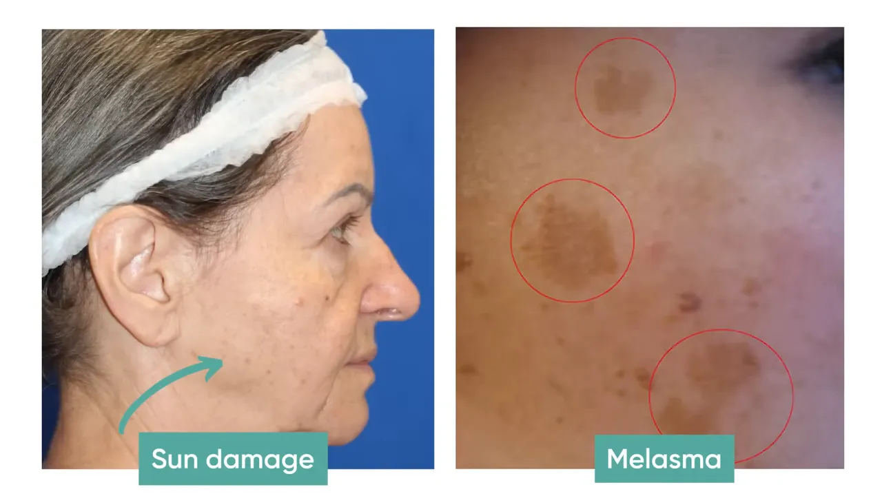 comparação lado a lado mostrando dano solar versus melasma com áreas destacadas em círculos