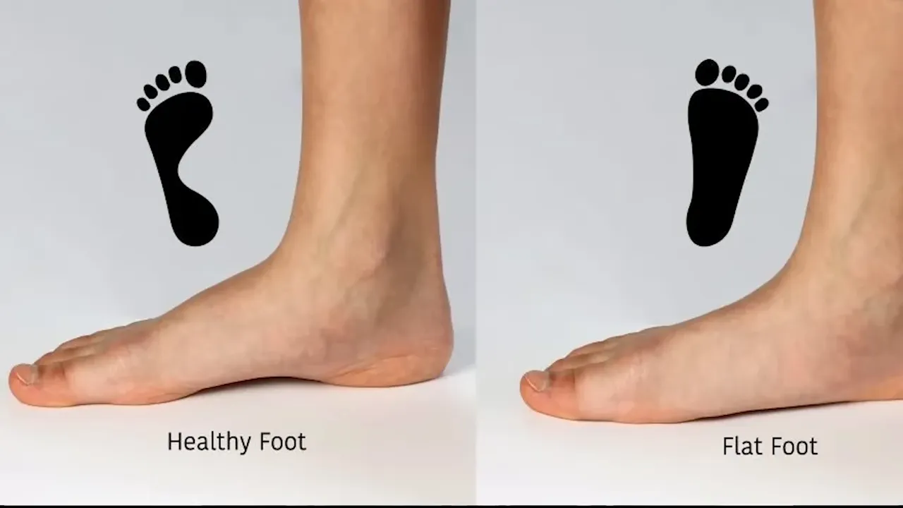 Side-by-side foot profiles and footprints labeled Healthy Foot and Flat Foot