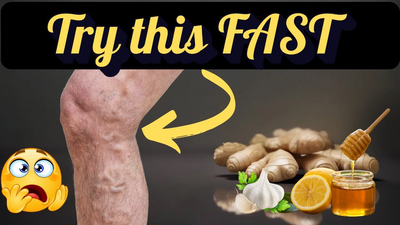 video thumbnail for 'Hidden Cure for Varicose Veins & Cold Feet'