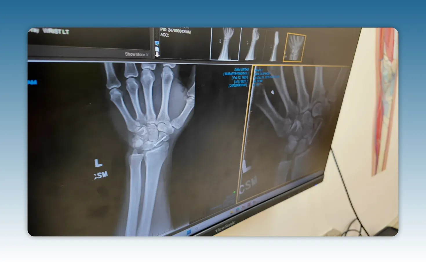 Medical monitor displaying X-ray images of a left wrist