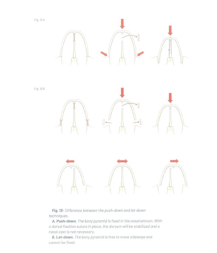 보존코성형 원리. Teorhinoplasty 참고.