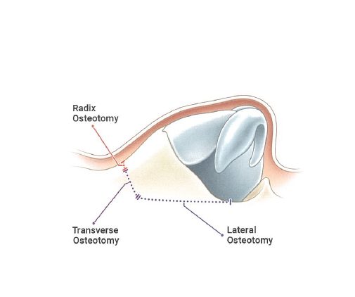 보존코성형 절골 방식. Teorhinoplasty 2 모식도
