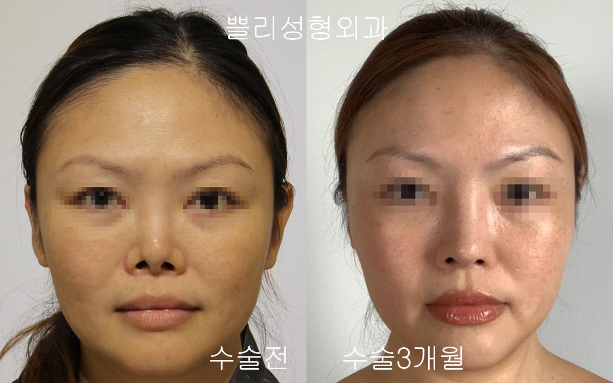Contracted nose appearing long after rhinoplasty: how is it approached?