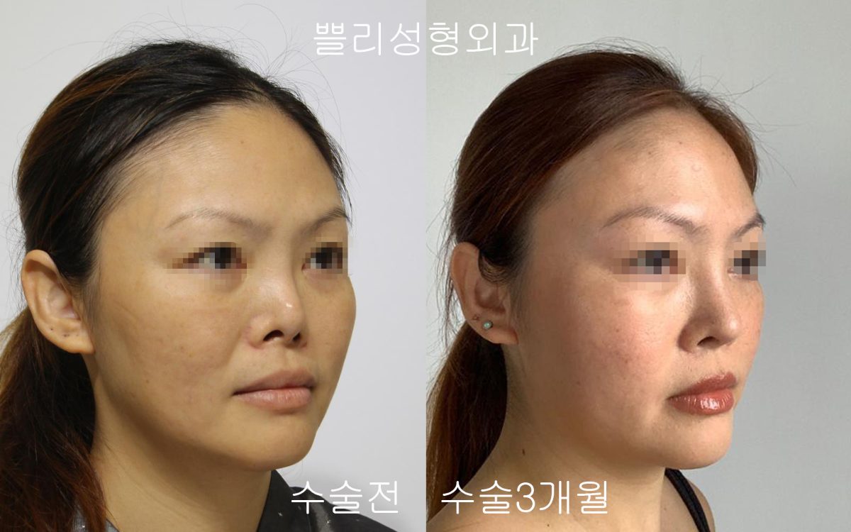 Contracted nose appearing long after rhinoplasty: how is it approached?