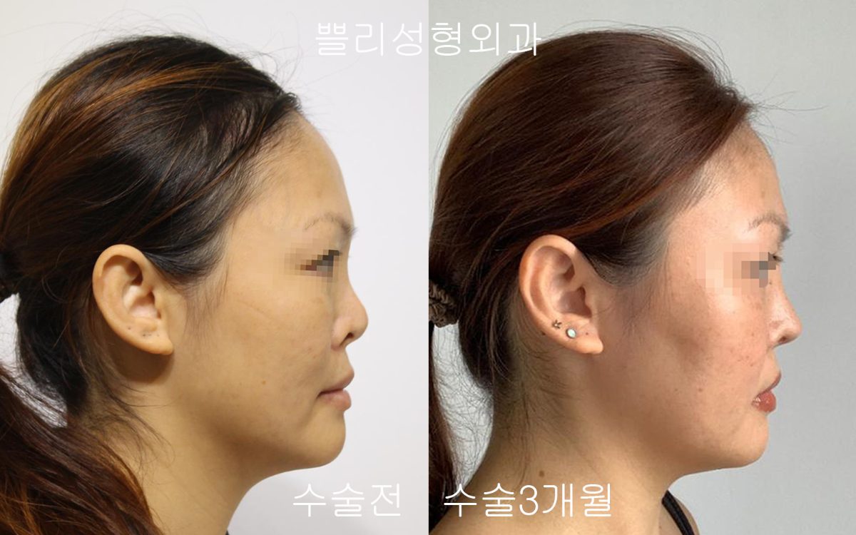 Contracted nose appearing long after rhinoplasty: how is it approached?