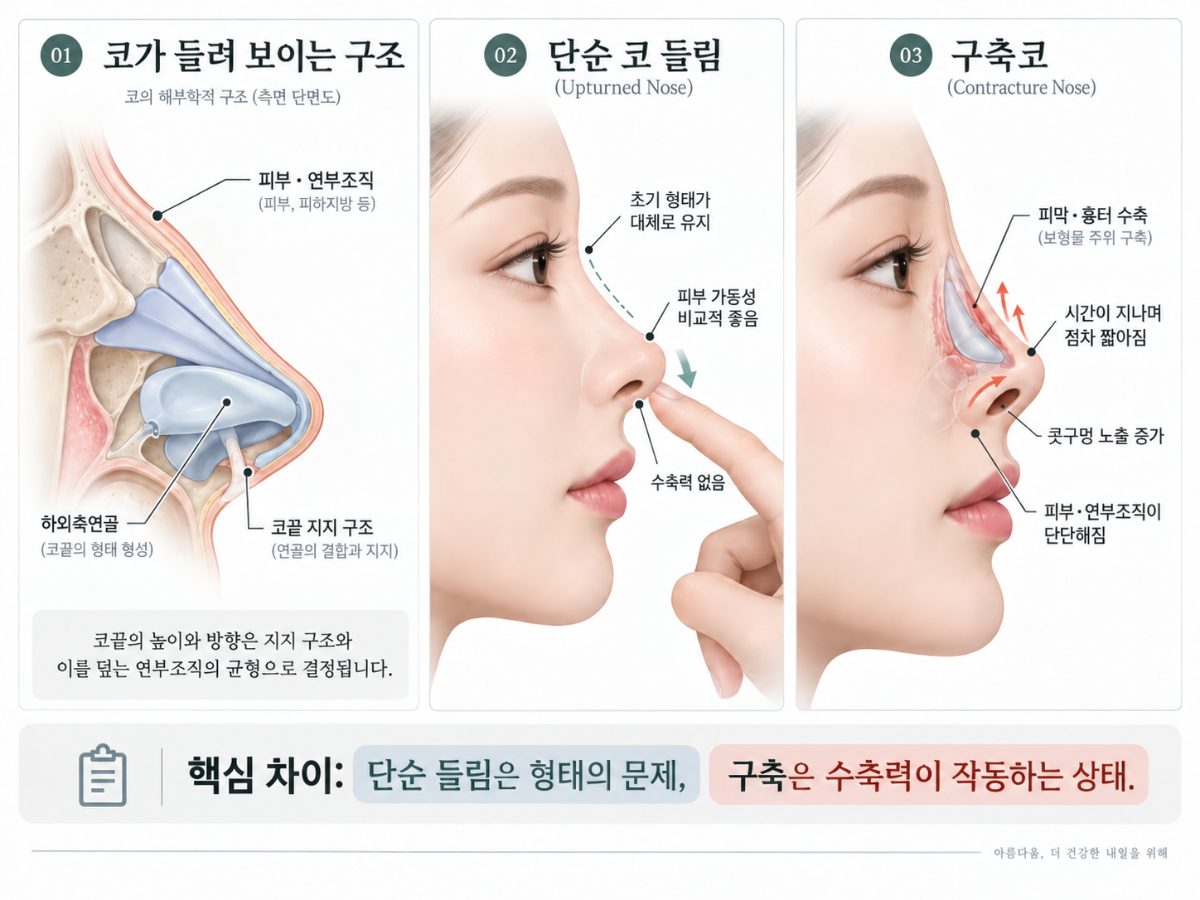 単なる鼻先の上向きと拘縮鼻は、どのように見分けますか?