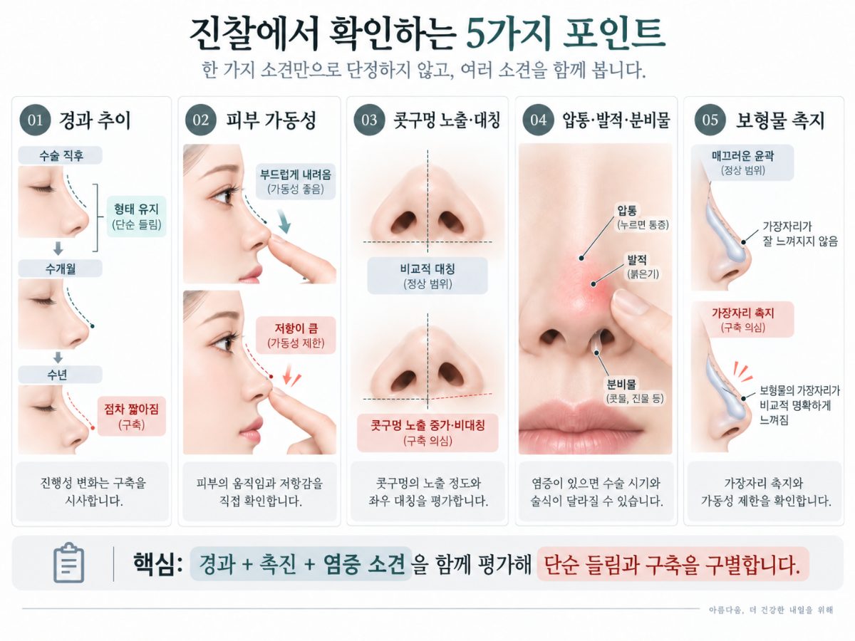 単なる鼻先の上向きと拘縮鼻は、どのように見分けますか?