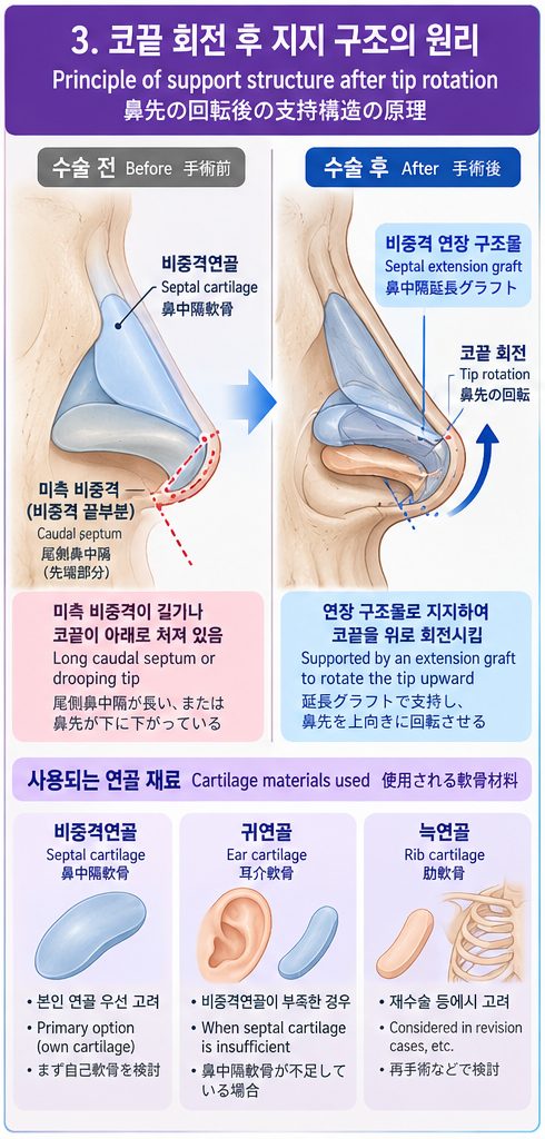 코끝 회전 후 지지 구조(비중격 연장 구조물) 원리 도식