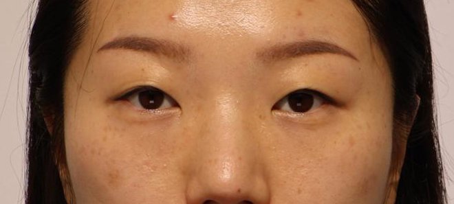 눈성형 시술 전 사진 (케이스 1)