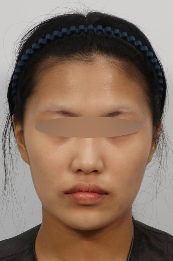 자가지방이식 시술 전 사진 (케이스 2)