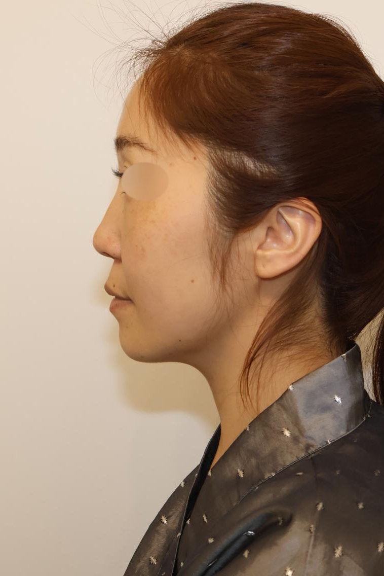 코성형 시술 전 사진 (케이스 1)