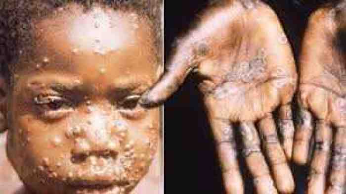 Tak Hanya Virus Corona, 5 Virus Ini Juga Pernah Gemparkan Dunia