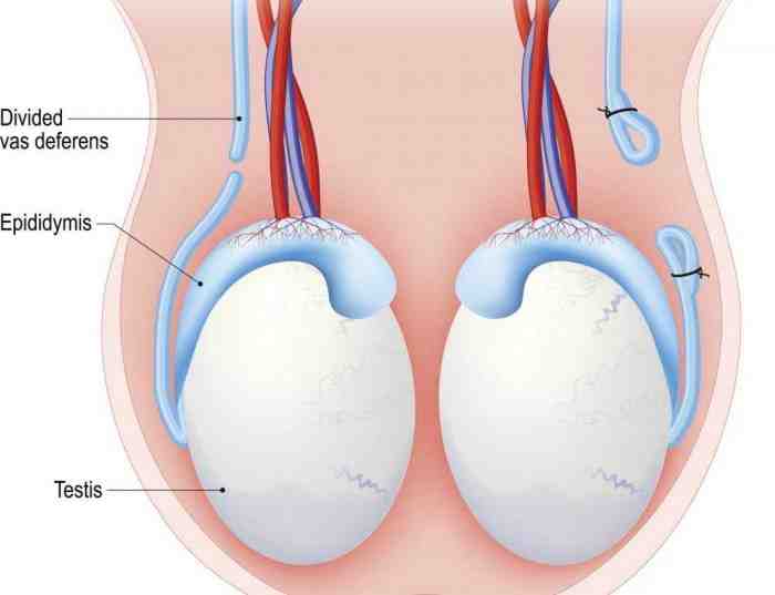Mengenal Jenis KB dan Efek Sampingnya
