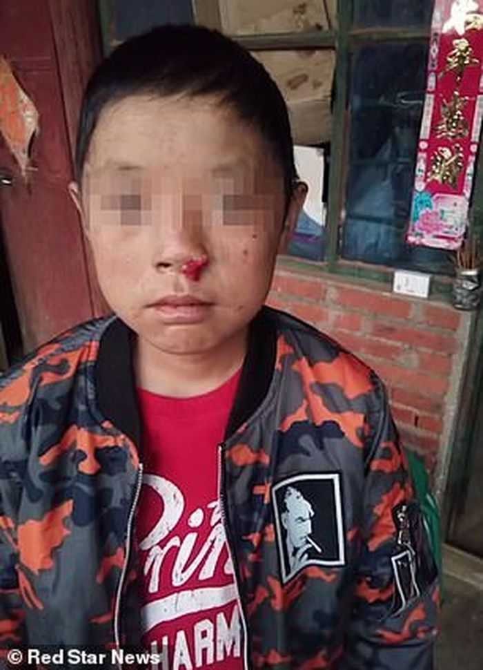 Lama Menderita Penyakit Langka, Bocah ini Berdarah Jika Terpapar Matahari Lama Menderita Penyakit Langka, Bocah ini Berdarah Jika Terpapar Matahari