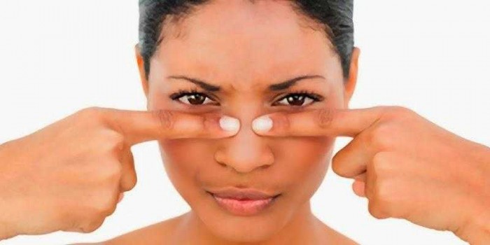 Penyebab Komedo Berlebih dan Cara Cepat Menghilangkannya Penyebab Komedo Berlebih dan Cara Cepat Menghilangkannya