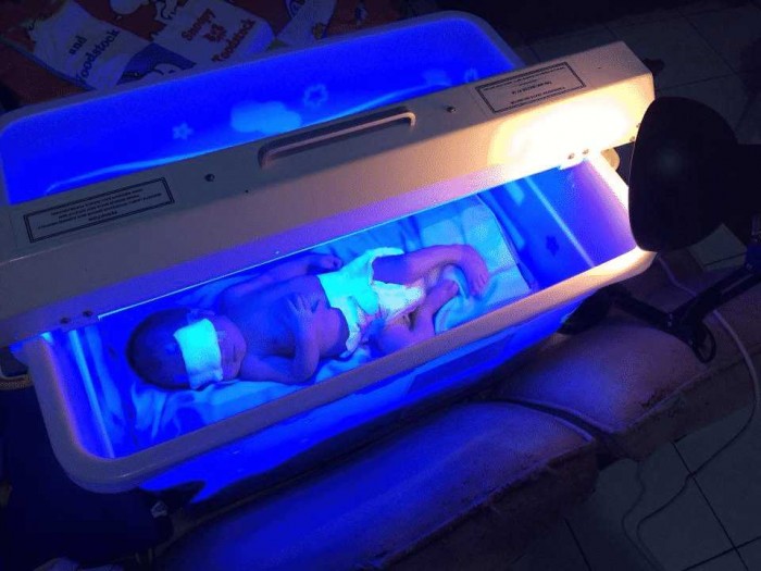 Penyebab, Gejala, dan Penanganan Bayi Baru Lahir Kuning