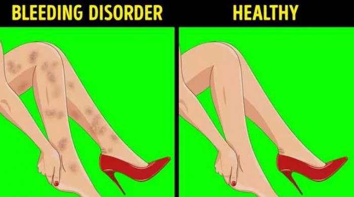 6 Tanda Kaki, Bukti Ada Masalah Kesehatan