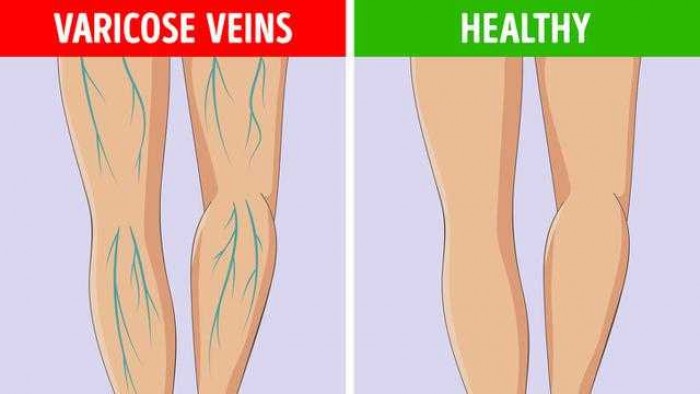 6 Tanda Kaki, Bukti Ada Masalah Kesehatan