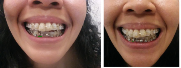 Gigi Tonggos Penyebab dan Cara Memperbaiki