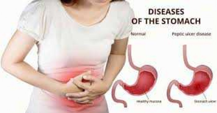 Ternyata Kunyit Sangat Ampuh untuk Maag